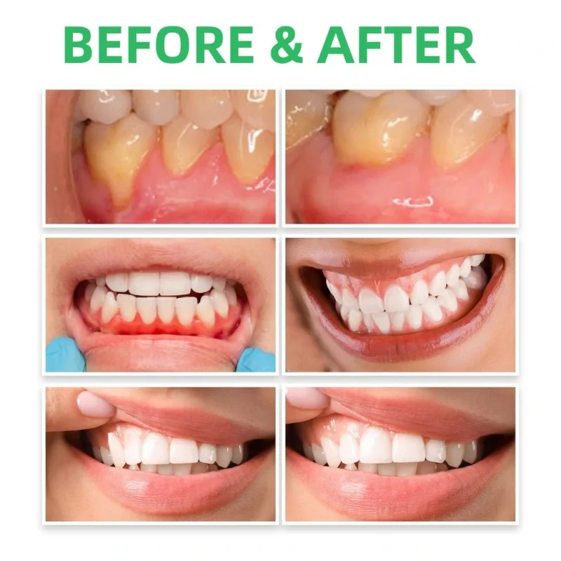 Gum Repair หยดบรรเทาถอนเหงือกบ - Teeth Whitening Paste บทวิจารณ์และราคา